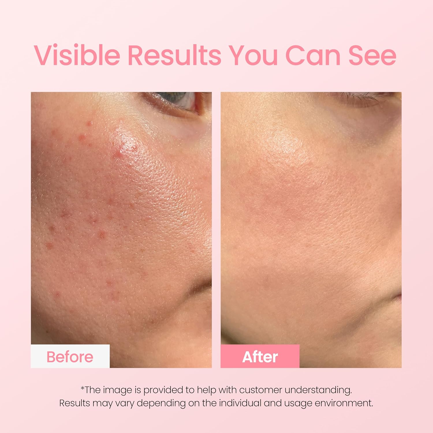 NEOGEN - Dermalogy A-Clear Soothing Pink Eraser 15ml-thekimyoung.com