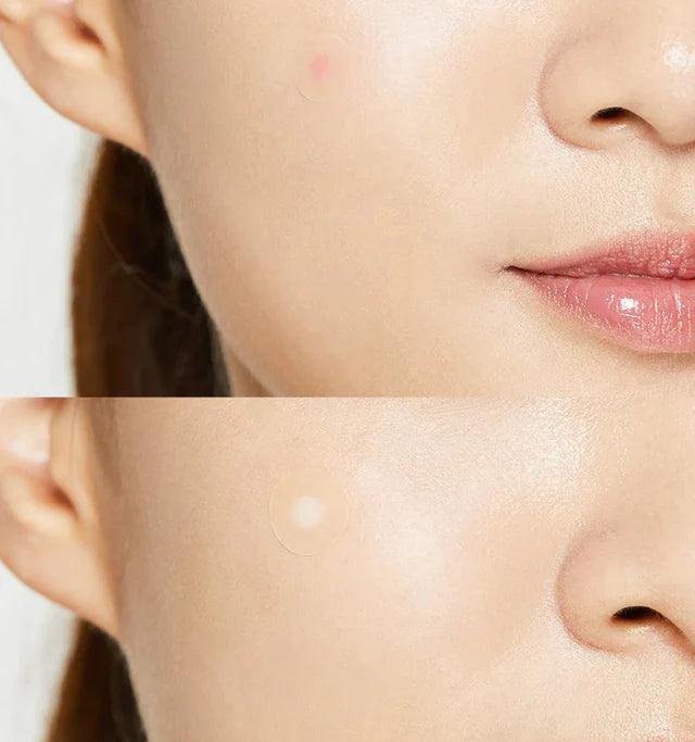 COSRX Acne Pimple Master Patch 24 Patches (3 Sizes) Acne patch COSRX