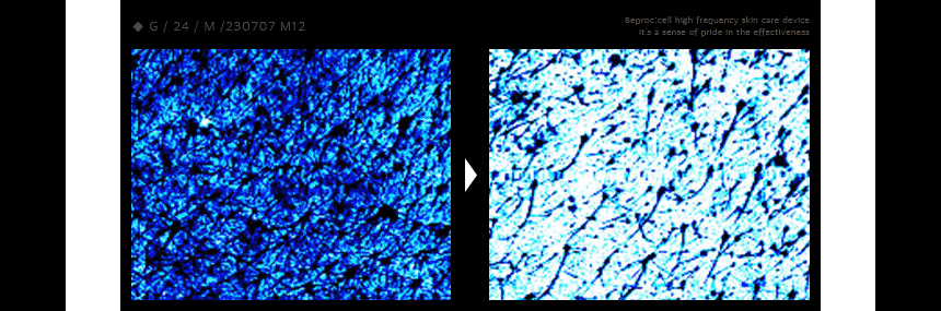 Beproxel high frequency massager galvanic beauty device Face Massager Beproxel