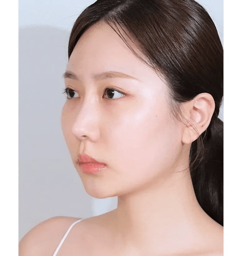 BIOHEAL BOH - Probioderm 3D Lifting Voluming Patch 4+1 Set (4.5gX5ea) [Oligio EDITION]-thekimyoung.com